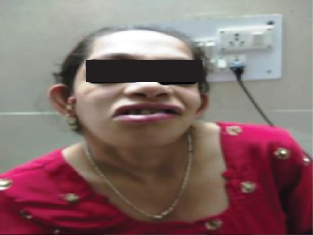 Facial asymmetry and preauricular tags