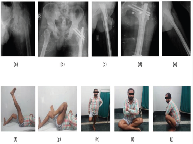 Radiograph of left hip showing AO31A3.1 fracture
